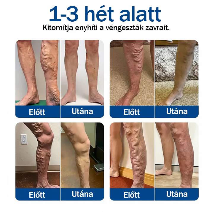 🇭🇺👨‍⚕️✅TAILEDEN® VeinEase Mikrotűs Kezelő Tapasz⚡Azonnali Megkönnyebbülés, Hosszú Távú Eredmények