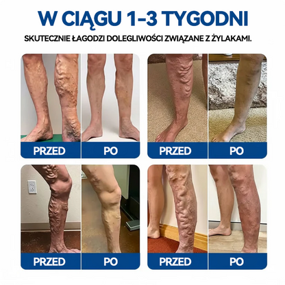 🤩🇵🇱👨‍⚕️✅TAILEDEN® VeinEase Plastry z Mikronakłuciami⚡Natychmiastowa ulga, długotrwałe rezultaty